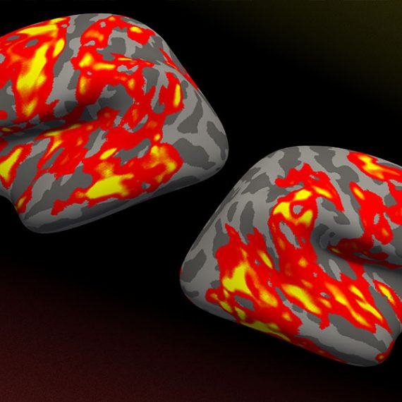 MRI showing neural signature of dyslexia