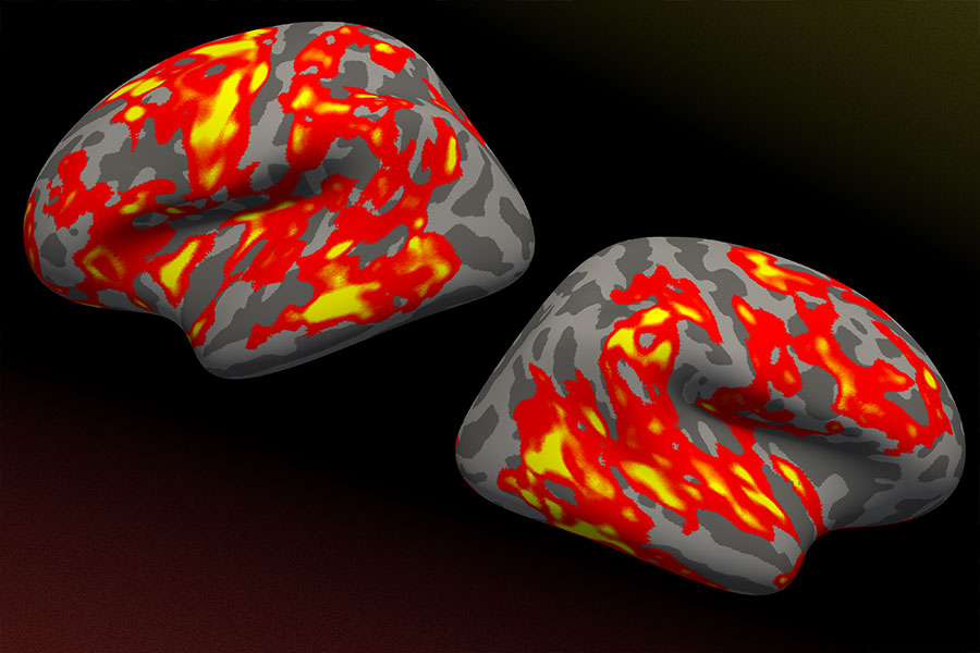 MRI showing neural signature of dyslexia