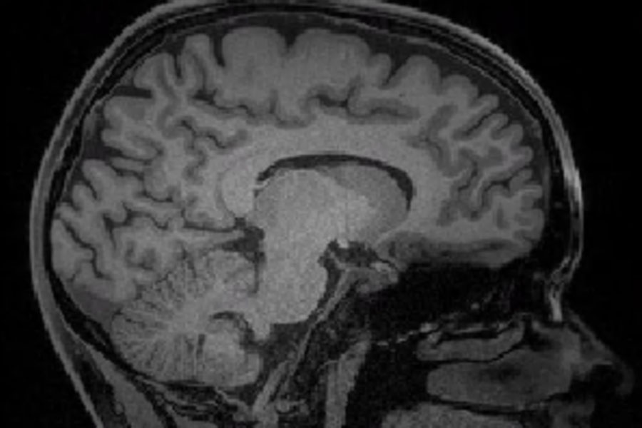 MRI scan of human brain