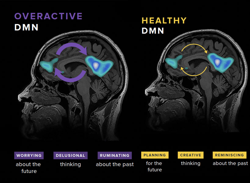 MRI images of two brains, one showing an active DMN and the other showing a healthy DMN.